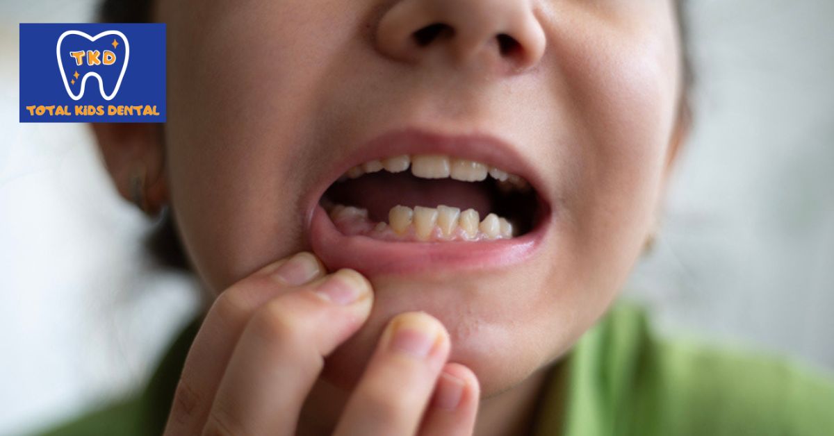 What Parents Need to Know About Saving a Knocked-Out Tooth Photo